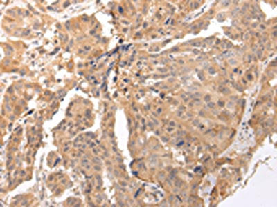 The image on the left is immunohistochemistry of paraffin-embedded Human breast cancer tissue using CSB-PA283108(CLDND2 Antibody) at dilution 1/45, on the right is treated with synthetic peptide. (Original magnification: ×200)