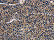 The image on the left is immunohistochemistry of paraffin-embedded Human liver cancer tissue using CSB-PA283183(IRF3 Antibody) at dilution 1/30, on the right is treated with fusion protein. (Original magnification: ×200)