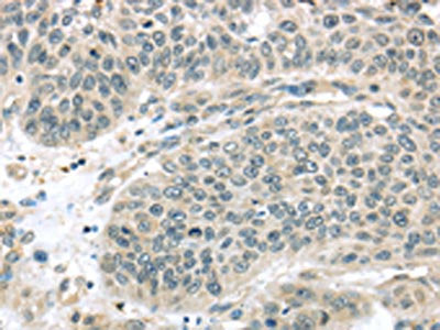 The image on the left is immunohistochemistry of paraffin-embedded Human lung cancer tissue using CSB-PA283261(THAP4 Antibody) at dilution 1/30, on the right is treated with fusion protein. (Original magnification: ×200)
