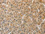 The image on the left is immunohistochemistry of paraffin-embedded Human liver cancer tissue using CSB-PA283369(MIP Antibody) at dilution 1/50, on the right is treated with fusion protein. (Original magnification: ×200)