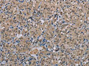 The image on the left is immunohistochemistry of paraffin-embedded Human thyroid cancer tissue using CSB-PA283398(MGLL Antibody) at dilution 1/40, on the right is treated with synthetic peptide. (Original magnification: ×200)