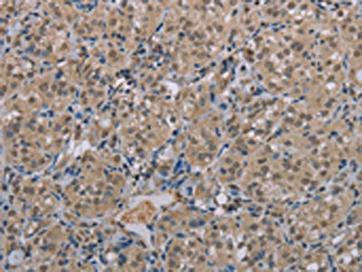 The image on the left is immunohistochemistry of paraffin-embedded Human thyroid cancer tissue using CSB-PA283398(MGLL Antibody) at dilution 1/40, on the right is treated with synthetic peptide. (Original magnification: ×200)
