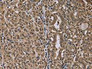 The image on the left is immunohistochemistry of paraffin-embedded Human thyroid cancer tissue using CSB-PA283408(NLRP6 Antibody) at dilution 1/40, on the right is treated with synthetic peptide. (Original magnification: ×200)