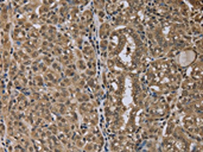 The image on the left is immunohistochemistry of paraffin-embedded Human thyroid cancer tissue using CSB-PA283408(NLRP6 Antibody) at dilution 1/40, on the right is treated with synthetic peptide. (Original magnification: ×200)