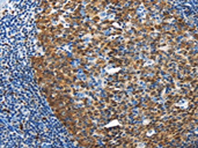 The image on the left is immunohistochemistry of paraffin-embedded Human tonsil tissue using CSB-PA283493(DCK Antibody) at dilution 1/20, on the right is treated with fusion protein. (Original magnification: ×200)
