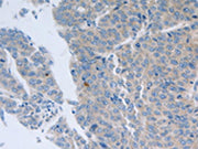 The image on the left is immunohistochemistry of paraffin-embedded Human liver cancer tissue using CSB-PA283513(GRIN1 Antibody) at dilution 1/50, on the right is treated with synthetic peptide. (Original magnification: ×200)