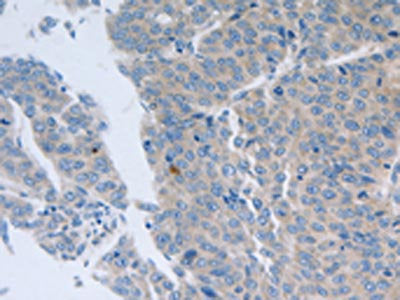 The image on the left is immunohistochemistry of paraffin-embedded Human liver cancer tissue using CSB-PA283513(GRIN1 Antibody) at dilution 1/50, on the right is treated with synthetic peptide. (Original magnification: ×200)