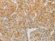 The image on the left is immunohistochemistry of paraffin-embedded Human liver cancer tissue using CSB-PA283716(ACSL4 Antibody) at dilution 1/60, on the right is treated with fusion protein. (Original magnification: ×200)