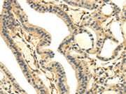 The image on the left is immunohistochemistry of paraffin-embedded Human thyroid cancer tissue using CSB-PA283805(UHRF1BP1 Antibody) at dilution 1/35, on the right is treated with synthetic peptide. (Original magnification: ×200)