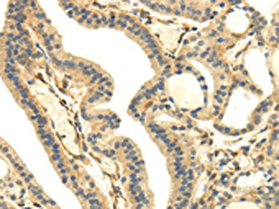 The image on the left is immunohistochemistry of paraffin-embedded Human thyroid cancer tissue using CSB-PA283805(UHRF1BP1 Antibody) at dilution 1/35, on the right is treated with synthetic peptide. (Original magnification: ×200)