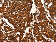 The image on the left is immunohistochemistry of paraffin-embedded Human breast cancer tissue using CSB-PA283839(CUEDC2 Antibody) at dilution 1/50, on the right is treated with fusion protein. (Original magnification: ×200)
