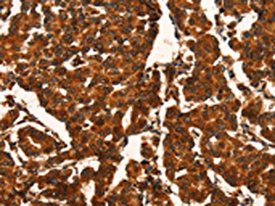 The image on the left is immunohistochemistry of paraffin-embedded Human breast cancer tissue using CSB-PA283839(CUEDC2 Antibody) at dilution 1/50, on the right is treated with fusion protein. (Original magnification: ×200)