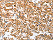 The image on the left is immunohistochemistry of paraffin-embedded Human thyroid cancer tissue using CSB-PA283856(CDR2 Antibody) at dilution 1/30, on the right is treated with fusion protein. (Original magnification: ×200)