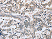 The image on the left is immunohistochemistry of paraffin-embedded Human liver cancer tissue using CSB-PA284123(PTGER1 Antibody) at dilution 1/30, on the right is treated with synthetic peptide. (Original magnification: ×200)