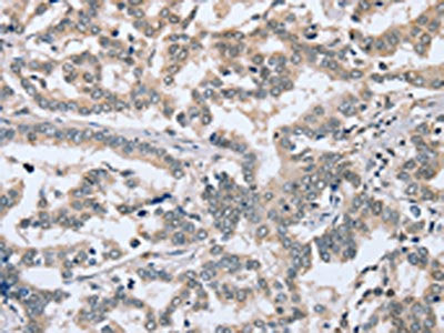The image on the left is immunohistochemistry of paraffin-embedded Human liver cancer tissue using CSB-PA284123(PTGER1 Antibody) at dilution 1/30, on the right is treated with synthetic peptide. (Original magnification: ×200)