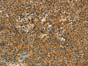 The image on the left is immunohistochemistry of paraffin-embedded Human liver cancer tissue using CSB-PA284200(NPAP1 Antibody) at dilution 1/60, on the right is treated with synthetic peptide. (Original magnification: ×200)