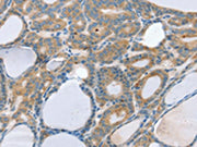 The image on the left is immunohistochemistry of paraffin-embedded Human thyroid cancer tissue using CSB-PA284397(SNX29 Antibody) at dilution 1/20, on the right is treated with synthetic peptide. (Original magnification: ×200)