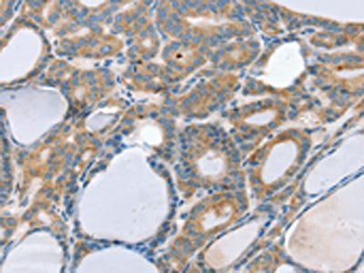 The image on the left is immunohistochemistry of paraffin-embedded Human thyroid cancer tissue using CSB-PA284397(SNX29 Antibody) at dilution 1/20, on the right is treated with synthetic peptide. (Original magnification: ×200)