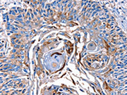 The image on the left is immunohistochemistry of paraffin-embedded Human esophagus cancer tissue using CSB-PA284465(LRP2 Antibody) at dilution 1/40, on the right is treated with synthetic peptide. (Original magnification: ×200)