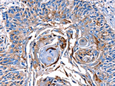 The image on the left is immunohistochemistry of paraffin-embedded Human esophagus cancer tissue using CSB-PA284465(LRP2 Antibody) at dilution 1/40, on the right is treated with synthetic peptide. (Original magnification: ×200)