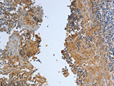 The image on the left is immunohistochemistry of paraffin-embedded Human tonsil tissue using CSB-PA284504(DLG4 Antibody) at dilution 1/30, on the right is treated with synthetic peptide. (Original magnification: ×200)
