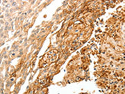 The image on the left is immunohistochemistry of paraffin-embedded Human cervical cancer tissue using CSB-PA284640(TGM1 Antibody) at dilution 1/30, on the right is treated with synthetic peptide. (Original magnification: ×200)
