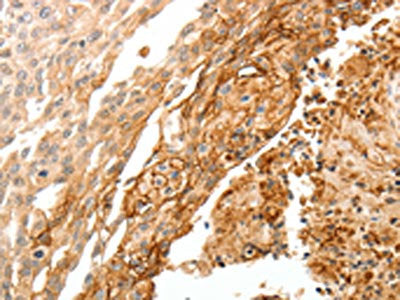 The image on the left is immunohistochemistry of paraffin-embedded Human cervical cancer tissue using CSB-PA284640(TGM1 Antibody) at dilution 1/30, on the right is treated with synthetic peptide. (Original magnification: ×200)