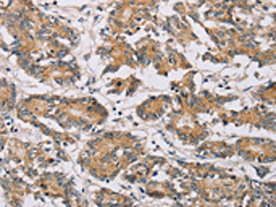 The image on the left is immunohistochemistry of paraffin-embedded Human colon cancer tissue using CSB-PA284832(MTFR1 Antibody) at dilution 1/30, on the right is treated with fusion protein. (Original magnification: ×200)
