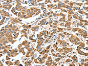 The image on the left is immunohistochemistry of paraffin-embedded Human breast cancer tissue using CSB-PA284873(ALDH9A1 Antibody) at dilution 1/50, on the right is treated with synthetic peptide. (Original magnification: ×200)