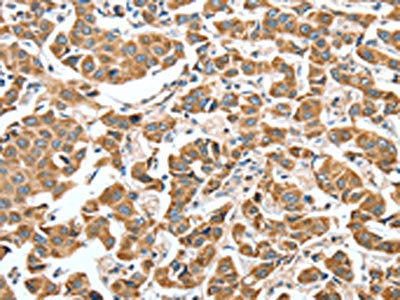 The image on the left is immunohistochemistry of paraffin-embedded Human breast cancer tissue using CSB-PA284873(ALDH9A1 Antibody) at dilution 1/50, on the right is treated with synthetic peptide. (Original magnification: ×200)