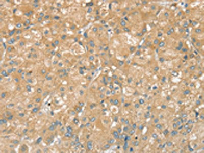 The image on the left is immunohistochemistry of paraffin-embedded Human liver cancer tissue using CSB-PA284952(PTPN7 Antibody) at dilution 1/20, on the right is treated with fusion protein. (Original magnification: ×200)