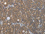 The image on the left is immunohistochemistry of paraffin-embedded Human thyroid cancer tissue using CSB-PA285011(PGR Antibody) at dilution 1/30, on the right is treated with synthetic peptide. (Original magnification: ×200)