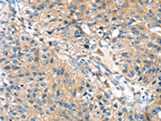 The image on the left is immunohistochemistry of paraffin-embedded Human breast cancer tissue using CSB-PA285123(STXBP4 Antibody) at dilution 1/35, on the right is treated with fusion protein. (Original magnification: ×200)