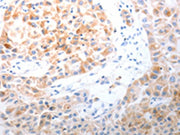 The image on the left is immunohistochemistry of paraffin-embedded Human lung cancer tissue using CSB-PA285192(LPPR5 Antibody) at dilution 1/20, on the right is treated with synthetic peptide. (Original magnification: ×200)