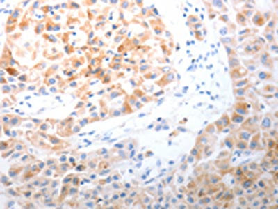 The image on the left is immunohistochemistry of paraffin-embedded Human lung cancer tissue using CSB-PA285192(LPPR5 Antibody) at dilution 1/20, on the right is treated with synthetic peptide. (Original magnification: ×200)