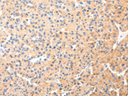 The image on the left is immunohistochemistry of paraffin-embedded Human liver cancer tissue using CSB-PA285300(KRT20 Antibody) at dilution 1/35, on the right is treated with synthetic peptide. (Original magnification: ×200)