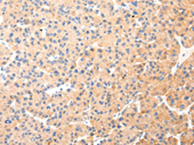 The image on the left is immunohistochemistry of paraffin-embedded Human liver cancer tissue using CSB-PA285300(KRT20 Antibody) at dilution 1/35, on the right is treated with synthetic peptide. (Original magnification: ×200)