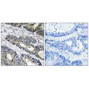Immunohistochemistry analysis of paraffin-embedded human colon carcinoma tissue using GLB1L3 antibody.