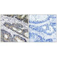 Immunohistochemistry analysis of paraffin-embedded human colon carcinoma tissue using GLB1L3 antibody.