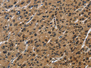 The image on the left is immunohistochemistry of paraffin-embedded Human liver cancer tissue using CSB-PA285442(SYN1 Antibody) at dilution 1/50, on the right is treated with synthetic peptide. (Original magnification: ×200)
