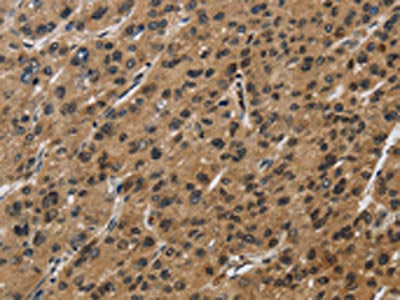 The image on the left is immunohistochemistry of paraffin-embedded Human liver cancer tissue using CSB-PA285442(SYN1 Antibody) at dilution 1/50, on the right is treated with synthetic peptide. (Original magnification: ×200)