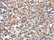 The image on the left is immunohistochemistry of paraffin-embedded Human thyroid cancer tissue using CSB-PA285547(ANP32C Antibody) at dilution 1/30, on the right is treated with synthetic peptide. (Original magnification: ×200)