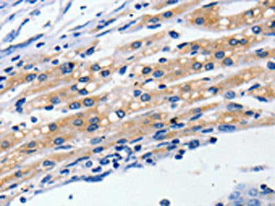 The image on the left is immunohistochemistry of paraffin-embedded Human liver cancer tissue using CSB-PA285560(CLDN5 Antibody) at dilution 1/5, on the right is treated with synthetic peptide. (Original magnification: ×200)