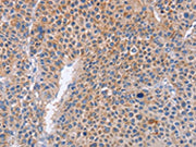 The image on the left is immunohistochemistry of paraffin-embedded Human liver cancer tissue using CSB-PA285585(PLK1 Antibody) at dilution 1/20, on the right is treated with fusion protein. (Original magnification: ×200)