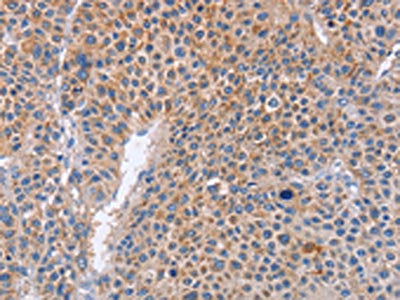 The image on the left is immunohistochemistry of paraffin-embedded Human liver cancer tissue using CSB-PA285585(PLK1 Antibody) at dilution 1/20, on the right is treated with fusion protein. (Original magnification: ×200)
