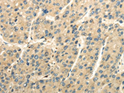 The image on the left is immunohistochemistry of paraffin-embedded Human liver cancer tissue using CSB-PA285591(UBAP2L Antibody) at dilution 1/25, on the right is treated with fusion protein. (Original magnification: ×200)