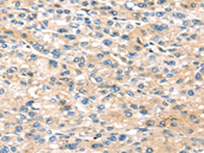 The image on the left is immunohistochemistry of paraffin-embedded Human liver cancer tissue using CSB-PA285619(THBS2 Antibody) at dilution 1/20, on the right is treated with synthetic peptide. (Original magnification: ×200)