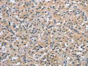 The image on the left is immunohistochemistry of paraffin-embedded Human thyroid cancer tissue using CSB-PA285697(C2orf40 Antibody) at dilution 1/20, on the right is treated with synthetic peptide. (Original magnification: ×200)