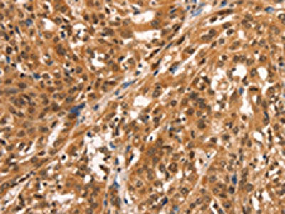 The image on the left is immunohistochemistry of paraffin-embedded Human esophagus cancer tissue using CSB-PA285746(CCNE2 Antibody) at dilution 1/25, on the right is treated with synthetic peptide. (Original magnification: ×200)