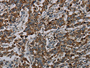 The image on the left is immunohistochemistry of paraffin-embedded Human liver cancer tissue using CSB-PA285771(CFLAR Antibody) at dilution 1/20, on the right is treated with synthetic peptide. (Original magnification: ×200)